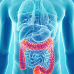 ULCERATIVE COLITIS